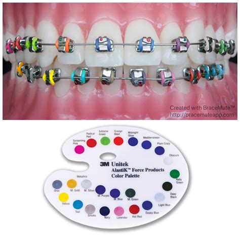 ethos orthodontics braces colours.